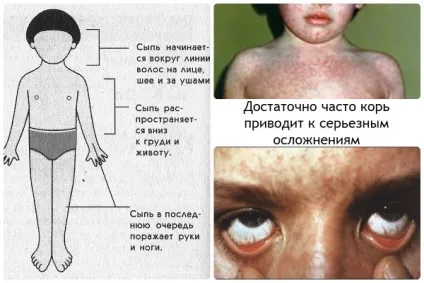 Що таке кір зараження, лікування, наслідки відео (лікування) Що таке кір зараження, лікування, наслідки відео