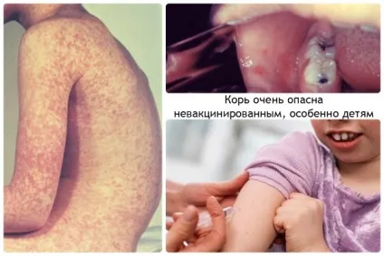 Що таке кір зараження, лікування, наслідки відео (лікування) Що таке кір зараження, лікування, наслідки відео