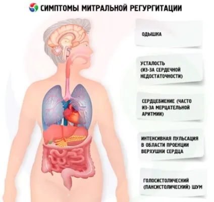 Що таке регургітація в кардіології (зворотний відтік крові) Що таке регургітація в кардіології