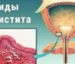 Цистит у хлопчиків причини, симптоми, лікування (симптоми) Цистит у хлопчиків причини, симптоми, лікування