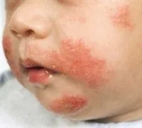 Цинкова мазь і цинкова паста для дітей і новонароджених показання і інструкція із застосування, (дітей) Цинкова мазь і цинкова паста для дітей і новонароджених показання і інструкція із застосування,