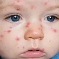 Цинкова мазь і цинкова паста для дітей і новонароджених показання і інструкція із застосування, (паста) Цинкова мазь і цинкова паста для дітей і новонароджених показання і інструкція із застосування,