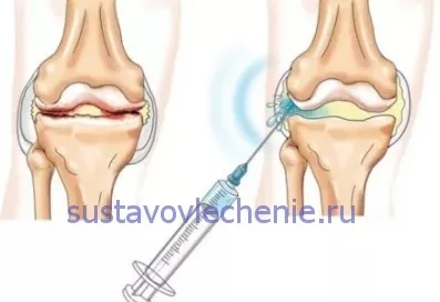 Деформуючий гонартроз колінного суглоба - лікування 1, 2, 3 ступеня, лікування суглобів (ступеня) Деформуючий гонартроз колінного суглоба - лікування 1, 2, 3 ступеня, лікування суглобів