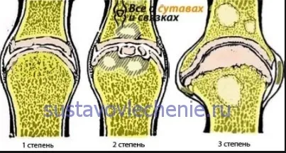 Деформуючий гонартроз колінного суглоба - лікування 1, 2, 3 ступеня, лікування суглобів (лікування) Деформуючий гонартроз колінного суглоба - лікування 1, 2, 3 ступеня, лікування суглобів