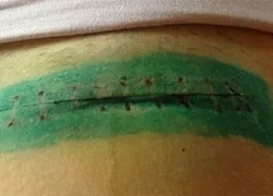 Дієта після видалення апендициту меню по днях (після) Дієта після видалення апендициту меню по днях