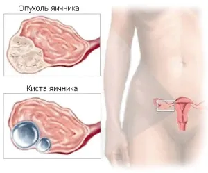 Дісгермінома яєчника симптоми і методи терапії