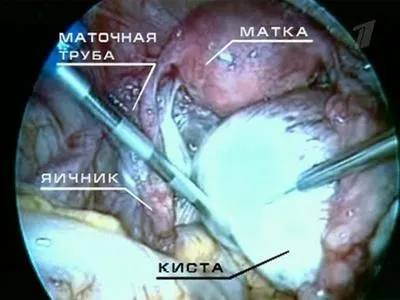 Дісгермінома яєчника причини, діагностика та лікування (діагностика) Дісгермінома яєчника причини, діагностика та лікування