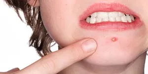 Фурункул причини, симптоми, лікування в домашніх умовах