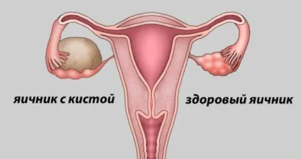 Геморагічний кіста яєчника (з геморагічним вмістом) діагностика кісти жовтого тіла,