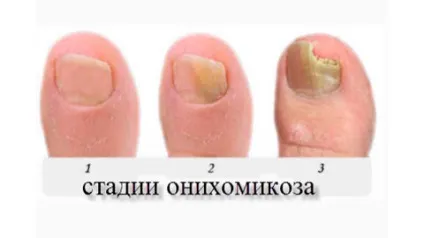Гиперкератоз нігтів - лікування грибка на ногах і руках, медичний сайт (нігтів) Гиперкератоз нігтів - лікування грибка на ногах і руках, медичний сайт