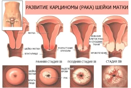 Генітальні бородавки лікування, причини та фото (вірусом папіломи людини) Генітальні бородавки лікування, причини та фото