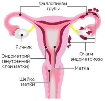 Гінекологічне захворювання ендометріоз (гінекологічне захворювання ендометріоз) Гінекологічне захворювання ендометріоз