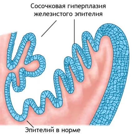 Гіперплазія шийки матки