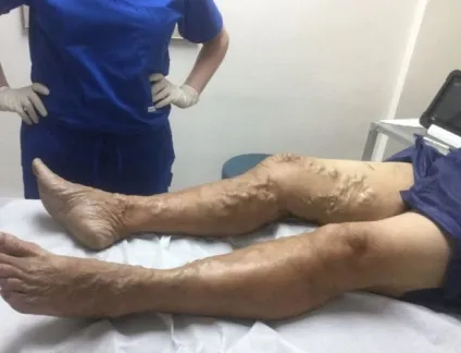 Флеботромбоз глибоких вен нижніх кінцівок що це таке, симптоми, лікування
