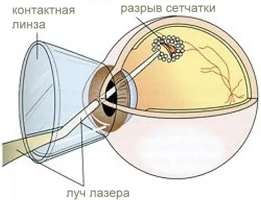 фундус лінзи