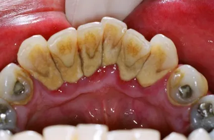 Галітоз, або чому з рота неприємно пахне, perfectsmile (причини поганого запаху) Галітоз, або чому з рота неприємно пахне, perfectsmile