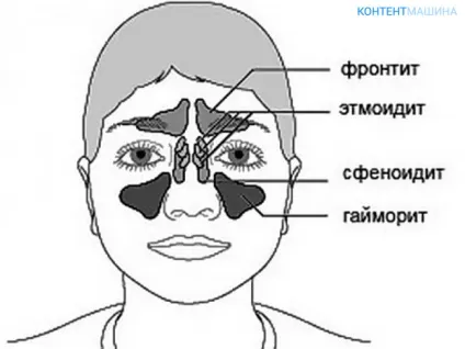 Гайморит і фронтит симптоми і лікування хвороб
