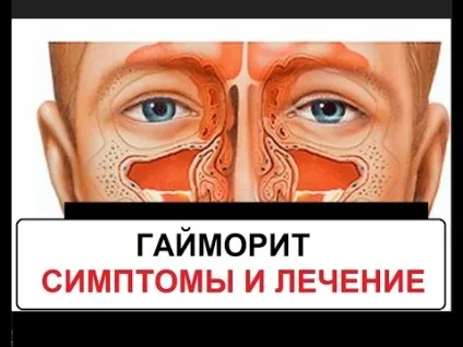 Гайморит грибковий симптоми і лікування, причини захворювання