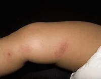 Герпес на нозі симптоми і лікування (Активізація вірусу типу) Герпес на нозі симптоми і лікування