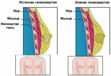 Гінекомастія у підлітків в 12-15 років (лікування) Гінекомастія у підлітків в 12-15 років