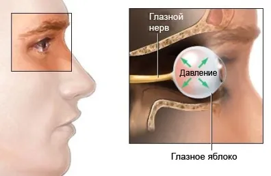 Глаукома у дітей - симптоми хвороби, профілактика і лікування глаукоми у дітей, причини захворювання і (симптоми) Глаукома у дітей - симптоми хвороби, профілактика і лікування глаукоми у дітей, причини захворювання і