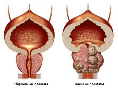 Гіпертрофія передміхурової залози симптоми, докладне опис захворювання, варіанти лікування (гіпертрофія передміхурової залози що це) Гіпертрофія передміхурової залози симптоми, докладне опис захворювання, варіанти лікування