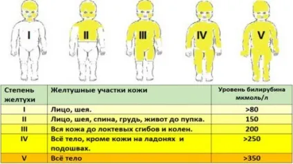 Гепатит у новонароджених симптоми і лікування вродженої форми (новонароджених) Гепатит у новонароджених симптоми і лікування вродженої форми