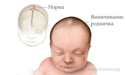 Гіпертензійного синдром що це таке - розвиток у дітей і дорослих