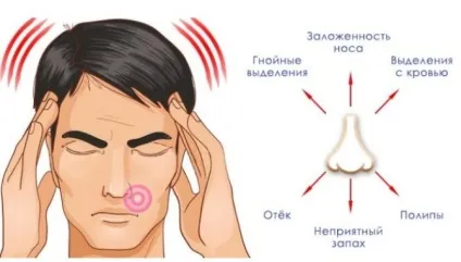 Грибковий гайморит симптоми і лікування (лікування) Грибковий гайморит симптоми і лікування