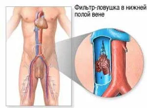 Ілеофеморальний тромбоз нижніх кінцівок лікування і симптоми гострої і звичайної форми (нижніх) Ілеофеморальний тромбоз нижніх кінцівок лікування і симптоми гострої і звичайної форми