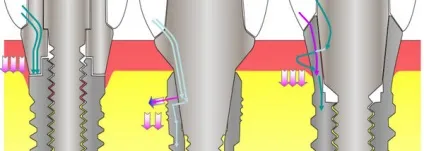 Імпланти марки implantium