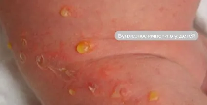 Імпетиго - стрептококової, буллезное і вульгарне лікування (лікування) Імпетиго - стрептококової, буллезное і вульгарне лікування