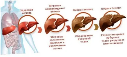 Як швидко і безпечно очистити печінку і привести організм в порядок (порядок) Як швидко і безпечно очистити печінку і привести організм в порядок