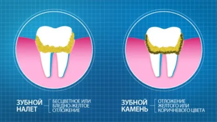 Через що з'являється карієс - розвиток карієсу і його причини