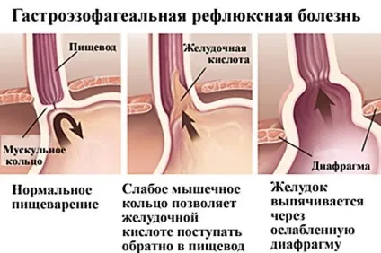 Печія у дитини причини і лікування симптомів (дитини) Печія у дитини причини і лікування симптомів