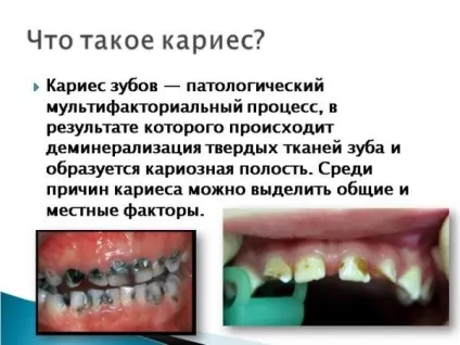 Через що з'являється карієс - розвиток карієсу і його причини