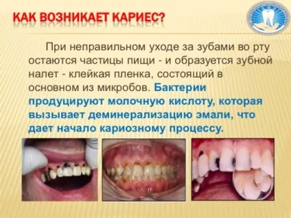 Через що з'являється карієс - розвиток карієсу і його причини