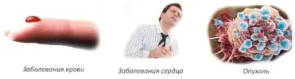 Гірудотерапія при грижі поперекового відділу хребта (поперекового) Гірудотерапія при грижі поперекового відділу хребта