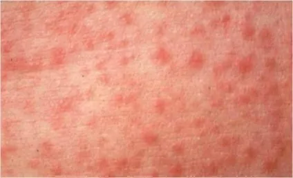 Гранули, плями Фордайса на губах, статевому, члені симптоми і лікування в домашніх умовах (статевому) Гранули, плями Фордайса на губах, статевому, члені симптоми і лікування в домашніх умовах