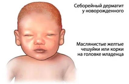 Гнейс у дітей причини появи кірочок на голові у дитини і видалення гнейсу (гнейс) Гнейс у дітей причини появи кірочок на голові у дитини і видалення гнейсу