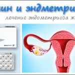 Як і чим лікувати ендометріоз матки і чи можна вилікувати - медикаментозно, хірургічно (можна) Як і чим лікувати ендометріоз матки і чи можна вилікувати - медикаментозно, хірургічно