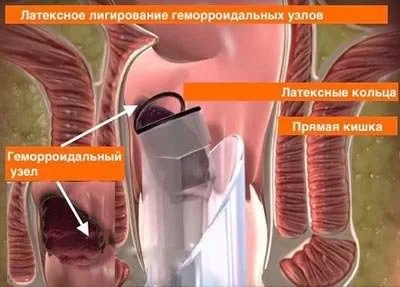 Як довго лікується геморой у чоловіків і жінок (безпосередньо залежить обраного) Як довго лікується геморой у чоловіків і жінок