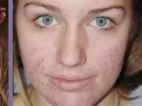 Як позбутися від слідів прищів ніж їх прибрати, кошти від шрамів (позбутися) Як позбутися від слідів прищів ніж їх прибрати, кошти від шрамів