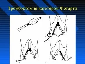 Як попередити і зупинити ілеофеморальний тромбоз - причини, симптоми і лікування (виникнення емболії легеневої) Як попередити і зупинити ілеофеморальний тромбоз - причини, симптоми і лікування