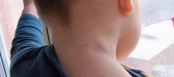 Як проявляється лімфома у дітей важливі симптоми