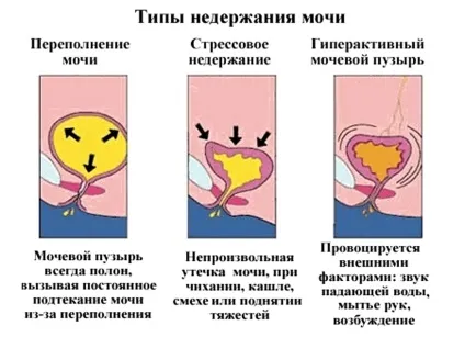 Як зміцнити сечовий міхур - харчування, комплекс вправ (харчування) Як зміцнити сечовий міхур - харчування, комплекс вправ