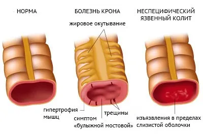 Як вилікувати неспецифічний виразковий коліт