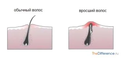 Як витягнути врослий волосся (врослий) Як витягнути врослий волосся