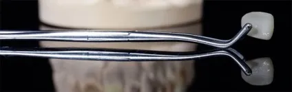 Керамічні вініри опис переваг, показання та недоліки (вініри) Керамічні вініри опис переваг, показання та недоліки