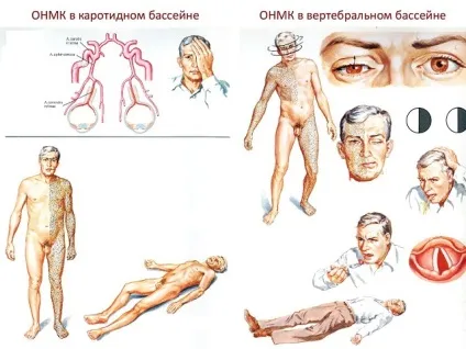 Каротидний басейн артерії, ангіографія (артерії) Каротидний басейн артерії, ангіографія